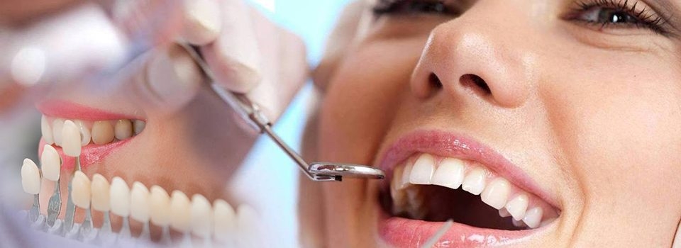 تلبيس الاسنان ابتسامة هوليوود 